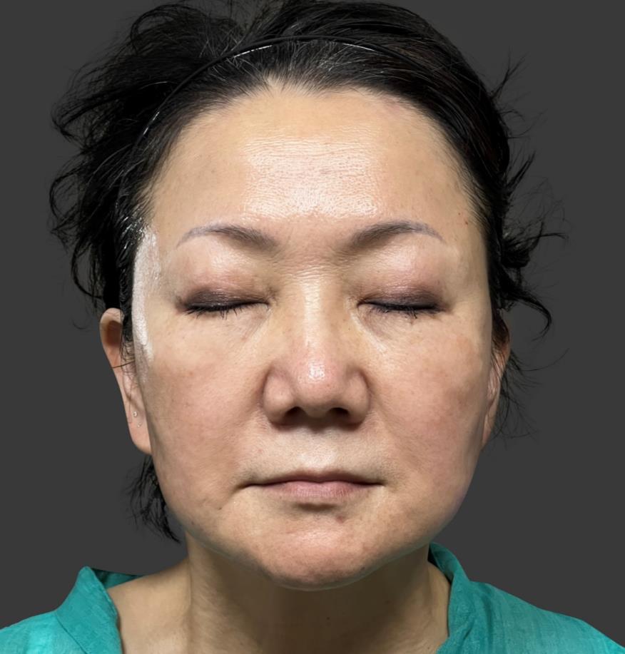 Clinical Case 1 - Full Face Lifting