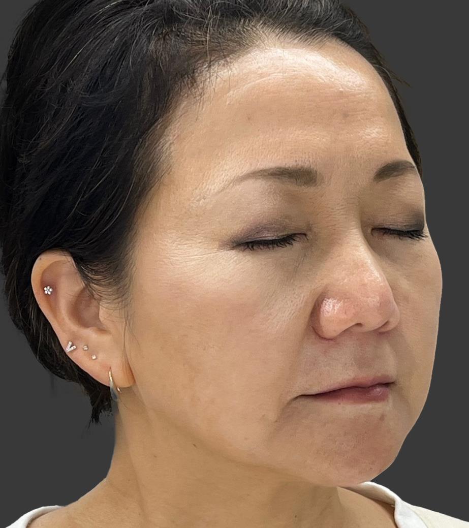 Clinical Case 2 - Jawline Tightening