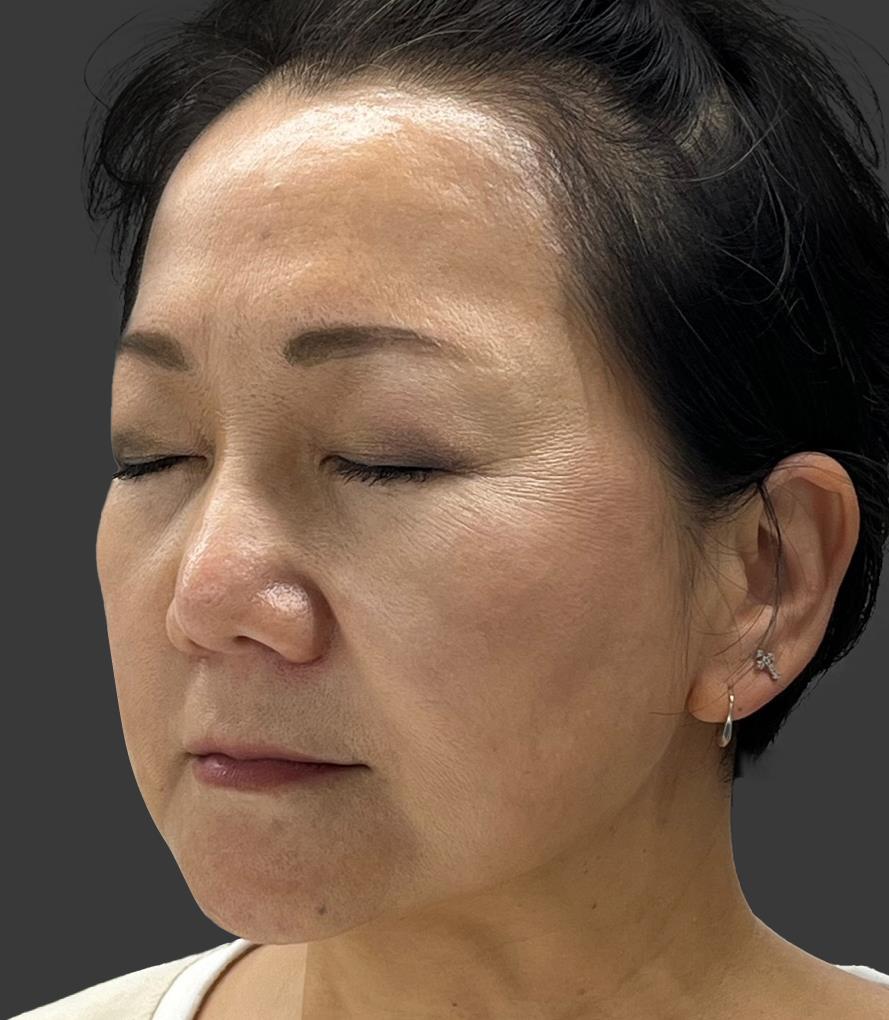 Clinical Case 3 - Nasolabial Improvement