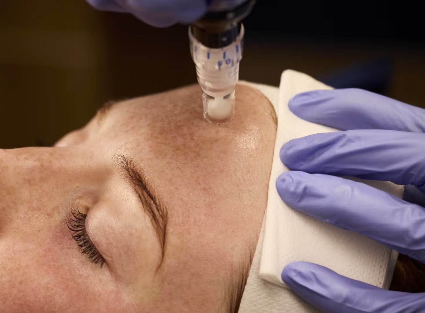 SkinPen Microneedling in Use